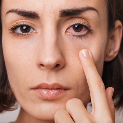 Comprender el síndrome del ojo seco: una guía completa para su prevención y tratamiento